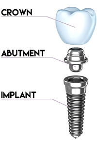 A diagram showing the parts of a dental implant