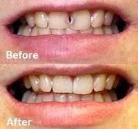 A before and after picture of a person 's teeth.