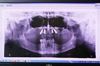 An x-ray of a skull and teeth on a computer screen.