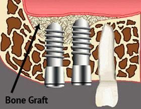 A diagram of a bone graft in a tooth.