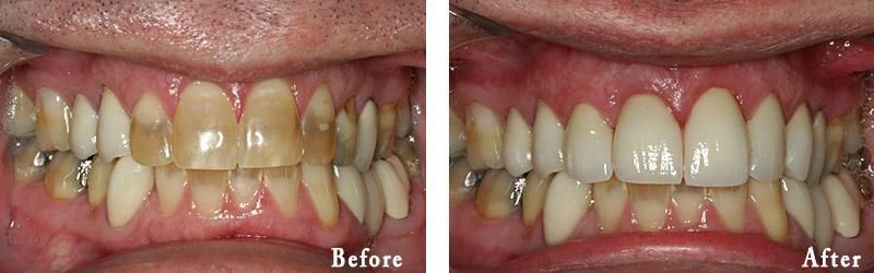 A before and after picture of a man 's teeth