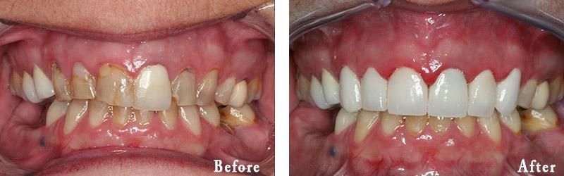 A before and after picture of a person 's teeth