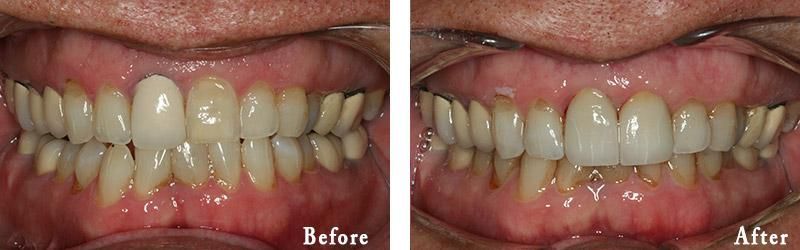 A before and after picture of a person 's teeth