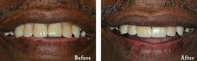 A before and after picture of a man 's teeth.