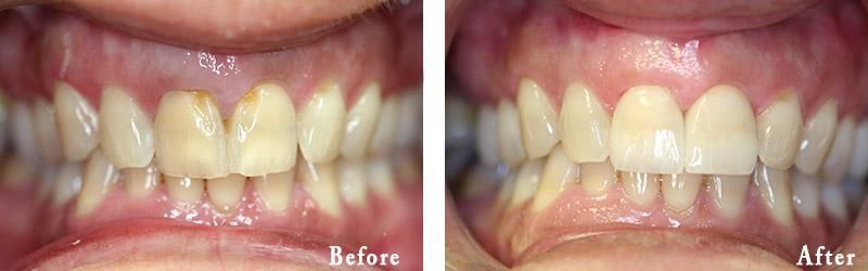 A before and after picture of a person 's teeth