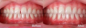 A before and after picture of a person 's teeth.