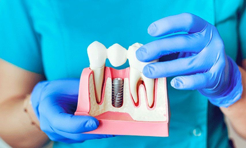 A dentist is holding a model of a dental implant in his hands.