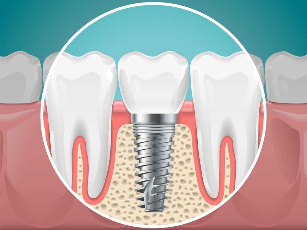 An illustration of a dental implant in a tooth.