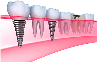 A row of teeth with a dental implant in the middle of them.