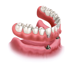 A close up of a denture with a screw in it