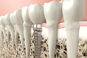 A row of teeth with a dental implant in the middle of them.