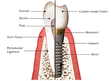 A diagram of a tooth and a dental implant