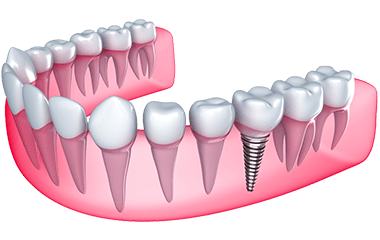 A close up of a tooth with a screw in it.