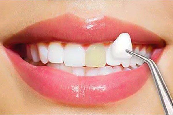 A close up of a woman 's teeth being examined by a dentist.