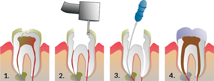 A diagram showing the stages of a tooth being extracted