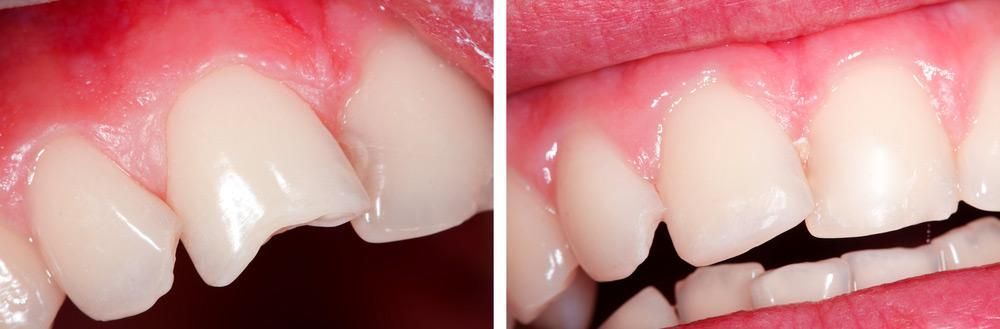 A before and after picture of a person 's teeth.