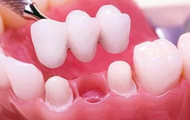 A close up of a model of a person 's teeth with a dental bridge.