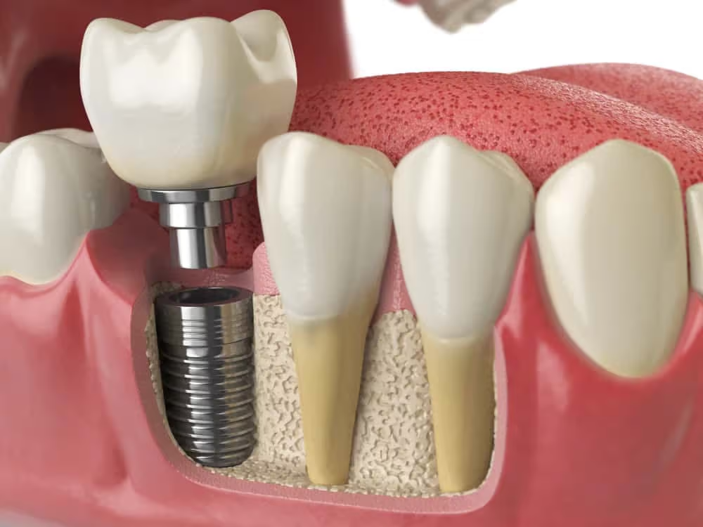 A model of a tooth with a dental implant in it.