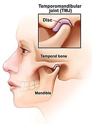 A diagram of the temporomandibular joint showing the disc and temporal bone