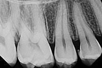 A black and white x-ray of a person 's teeth.