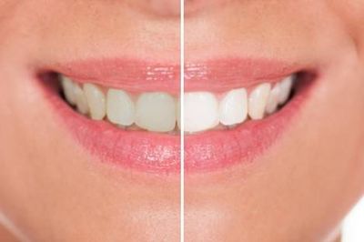 Smiling Teeth - Dentistry in Santa Barbara, CA