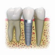 Teeth Before and After - Cleaning Cleaning in Santa Barbara, CA