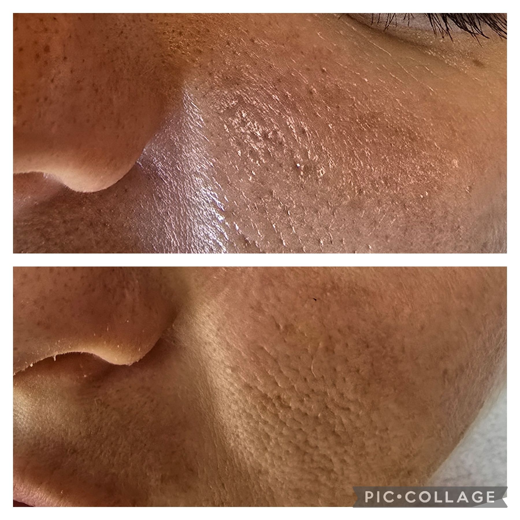 Before-and-after photos of skin texture on a person's face, showing improvement in skin smoothness.