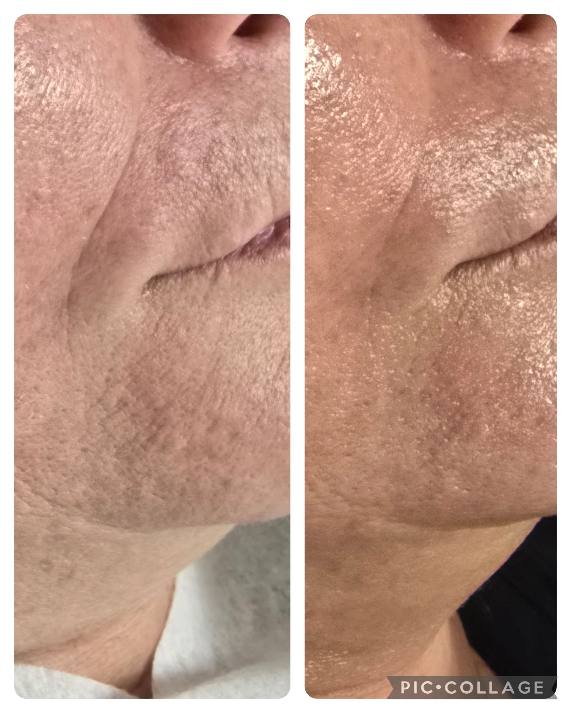 Side-by-side comparison of a person's face before and after a skin treatment.