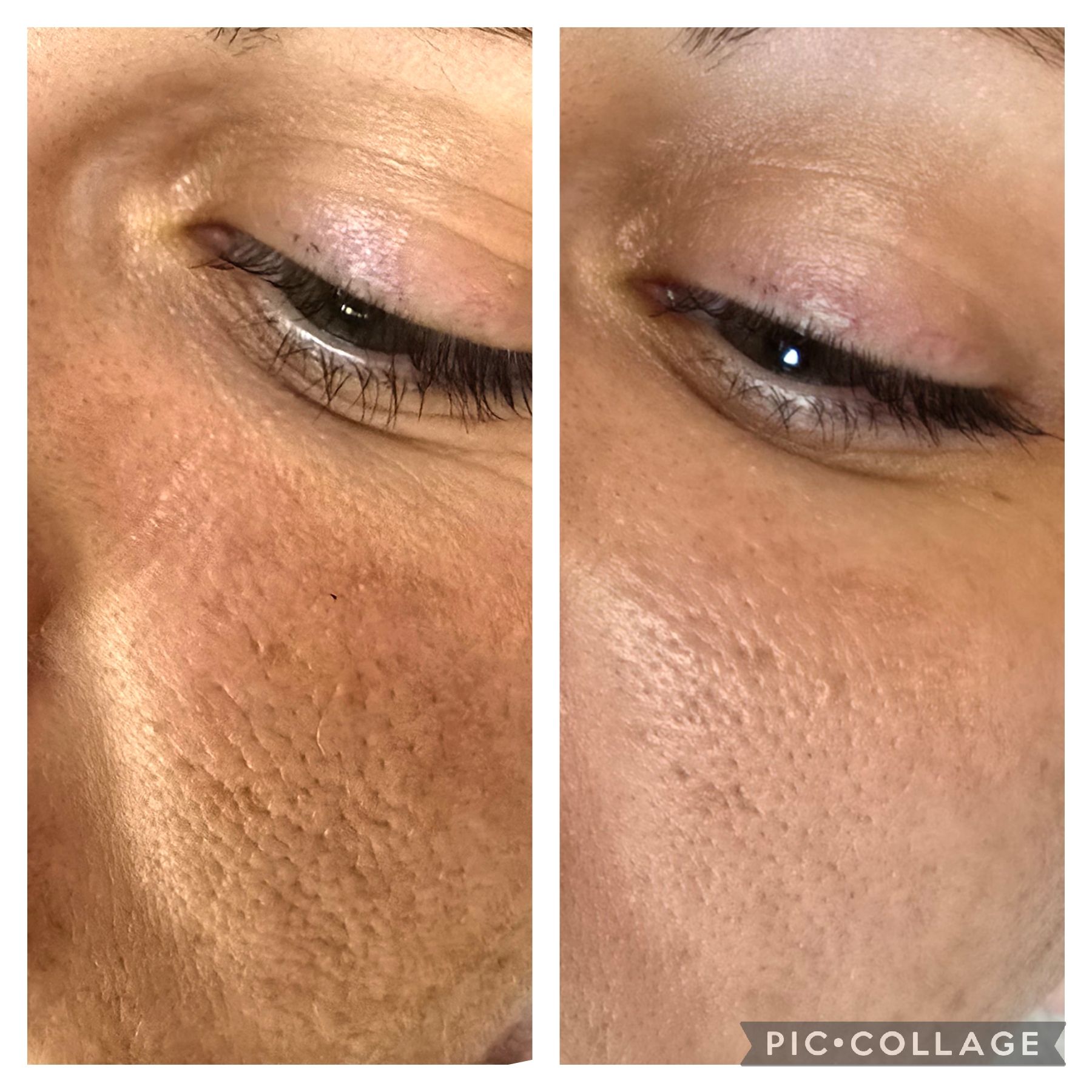 Comparison of a person's cheek before and after treatment.