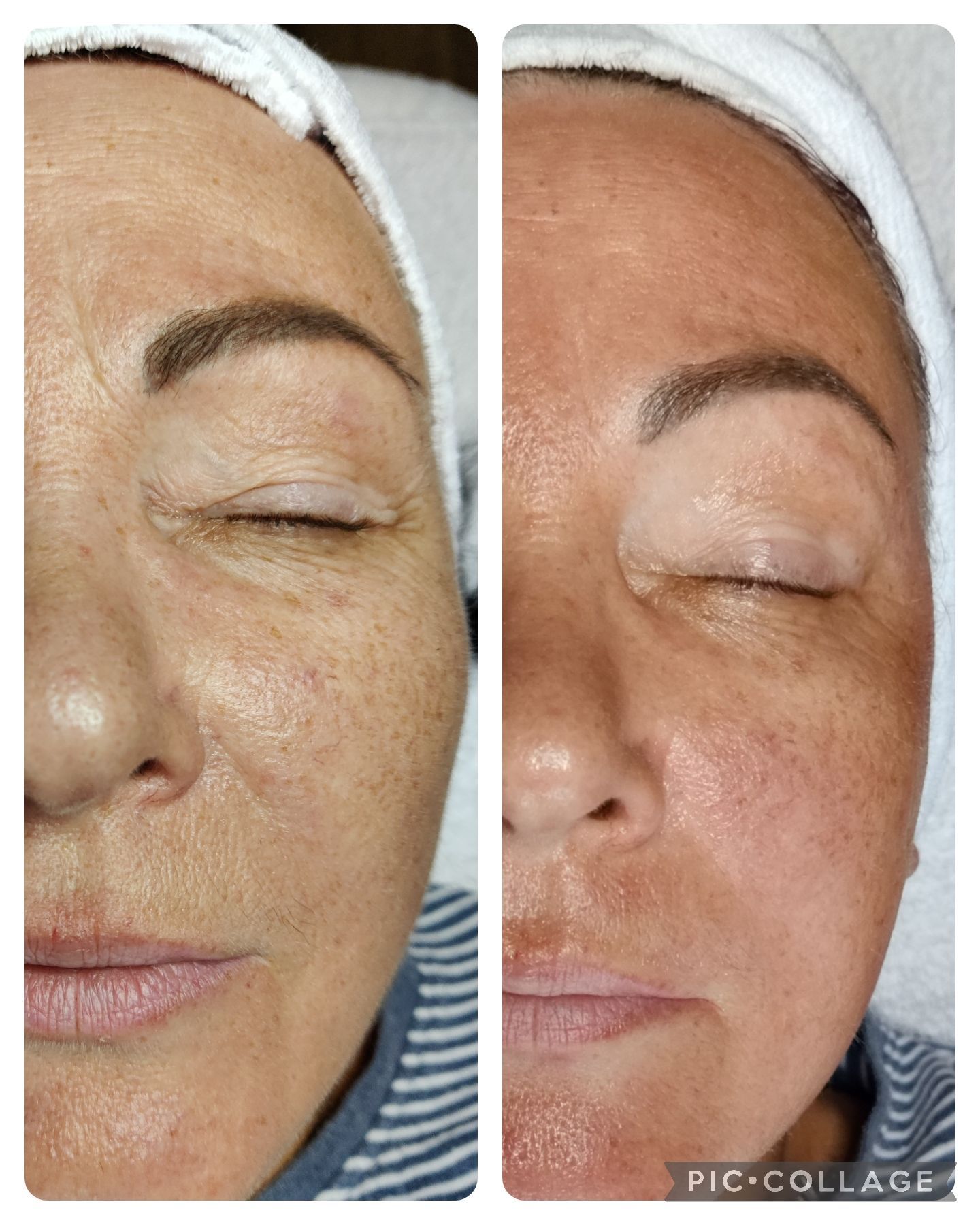 Before-and-after comparison of a woman's face. Left: Wrinkled skin, right: Smoother skin with reduced discoloration.