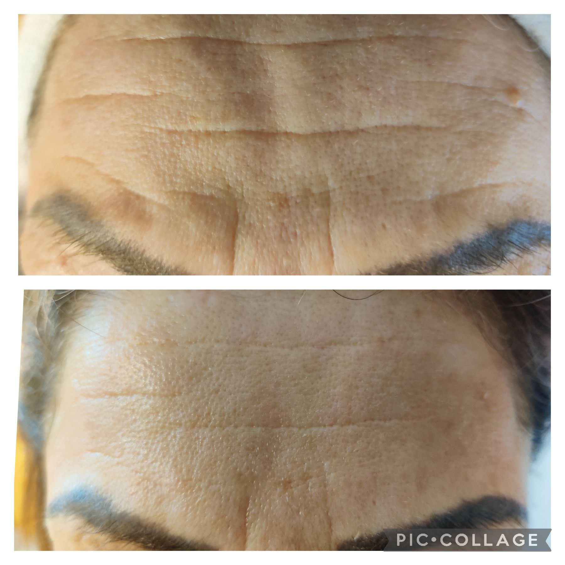 Top: Forehead with deep wrinkles. Bottom: Forehead with reduced wrinkles, smoother appearance.