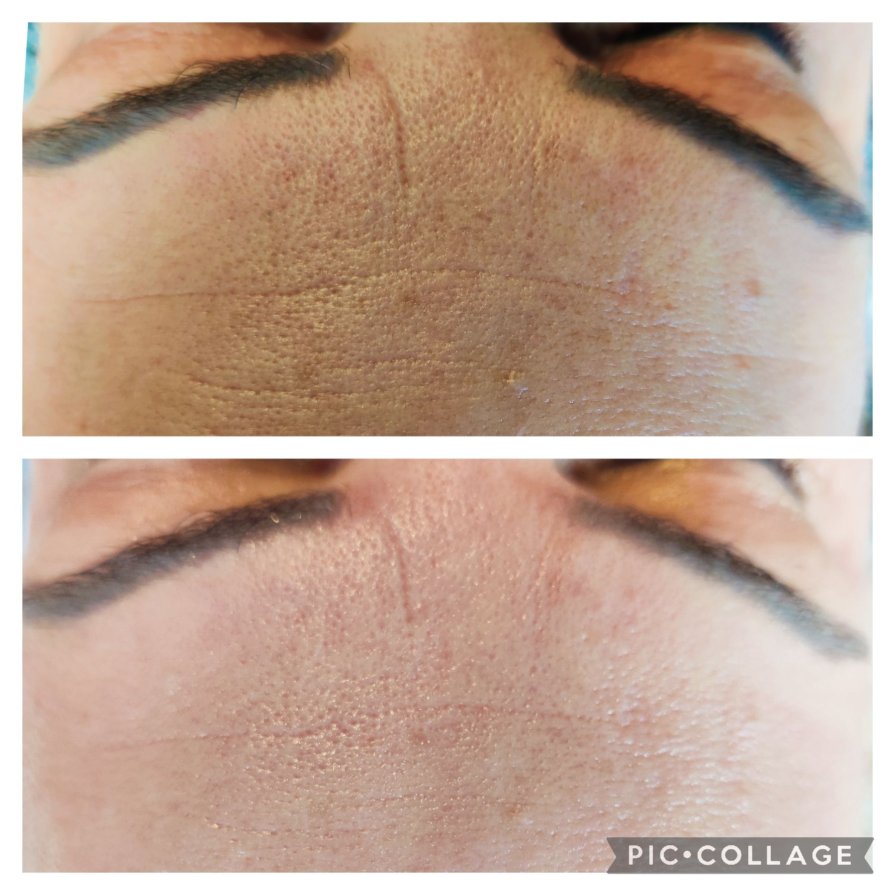 Before and after photos of a person's forehead, showing a reduction in wrinkles after a cosmetic procedure.