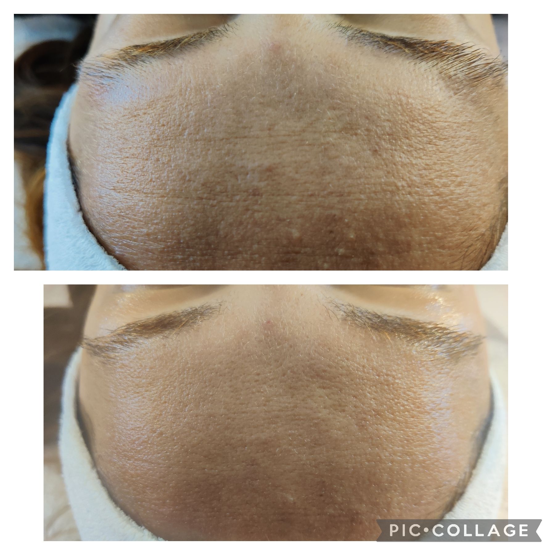 Before and after view of a forehead, showing a smoother skin texture after a skincare treatment.