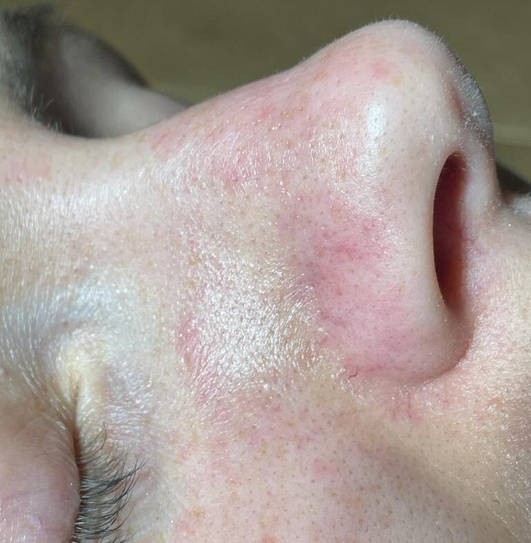 Close-up of a person's nose, showing skin texture with redness and visible pores.