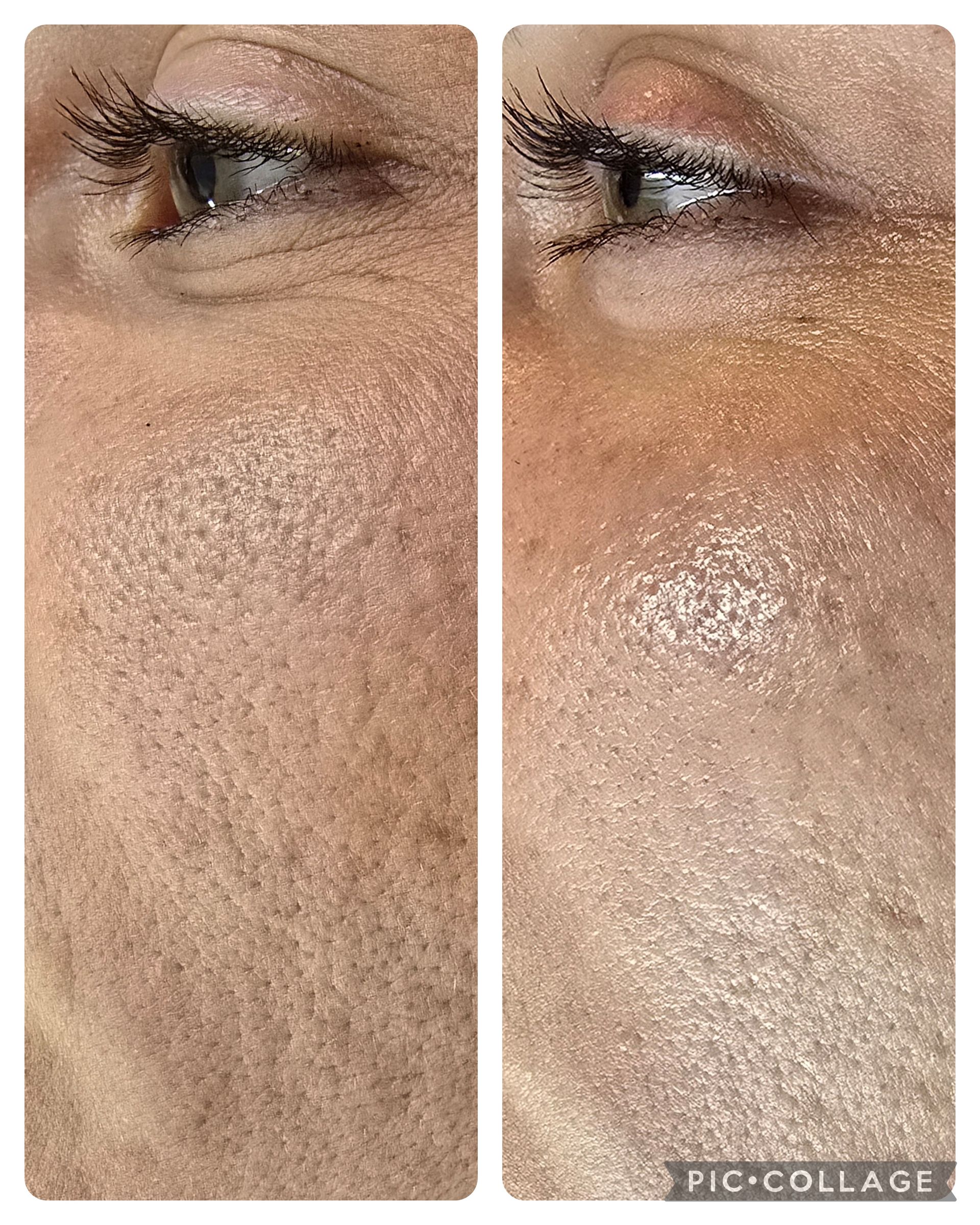 Side-by-side comparison of a face; left side has wrinkles, right is smoother; both show skin pores near eyes.