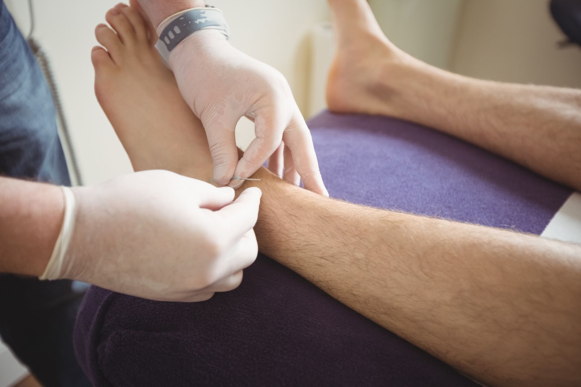 A person is getting an acupuncture treatment on their leg.