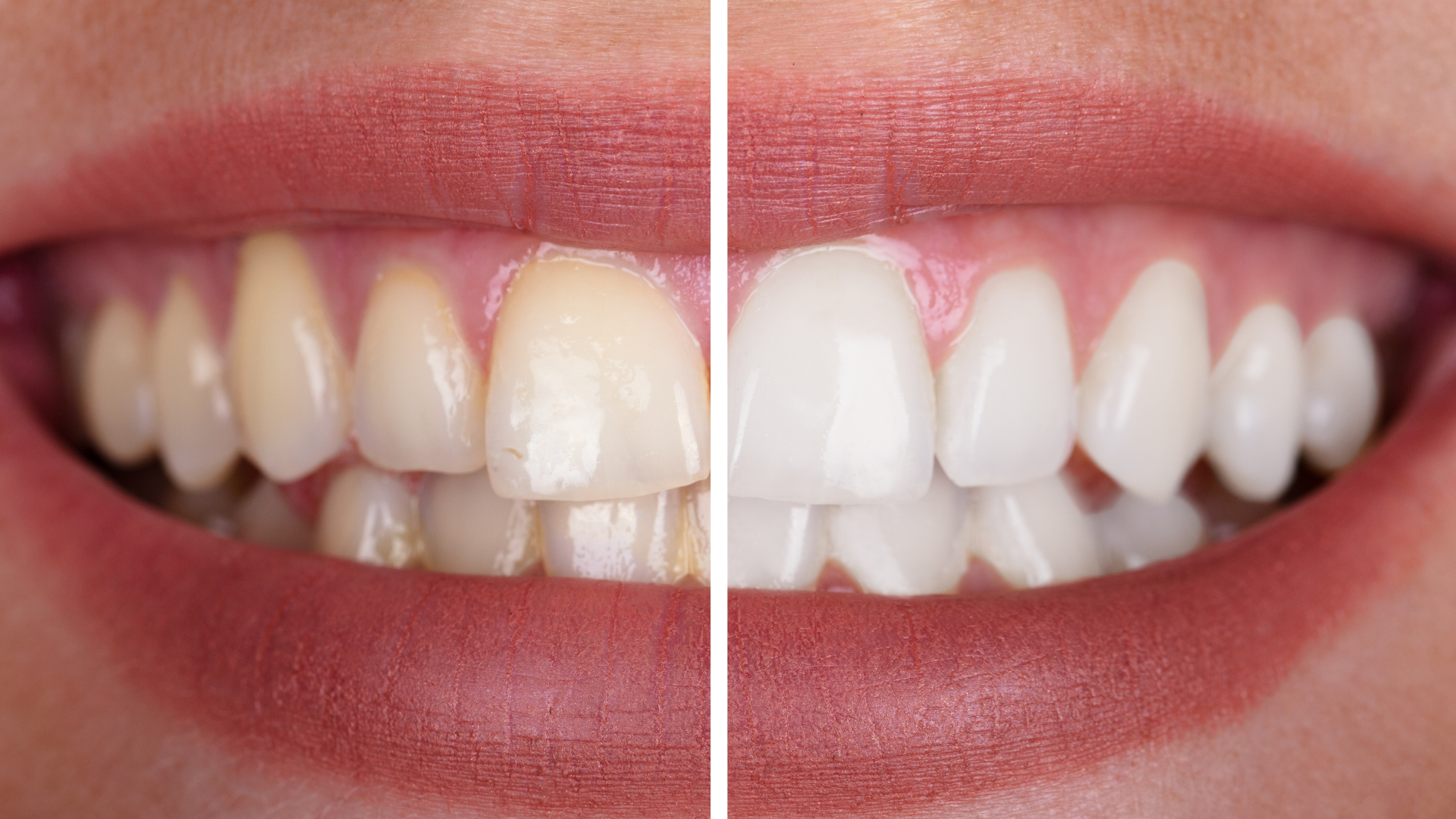 A before and after photo of a woman 's teeth.