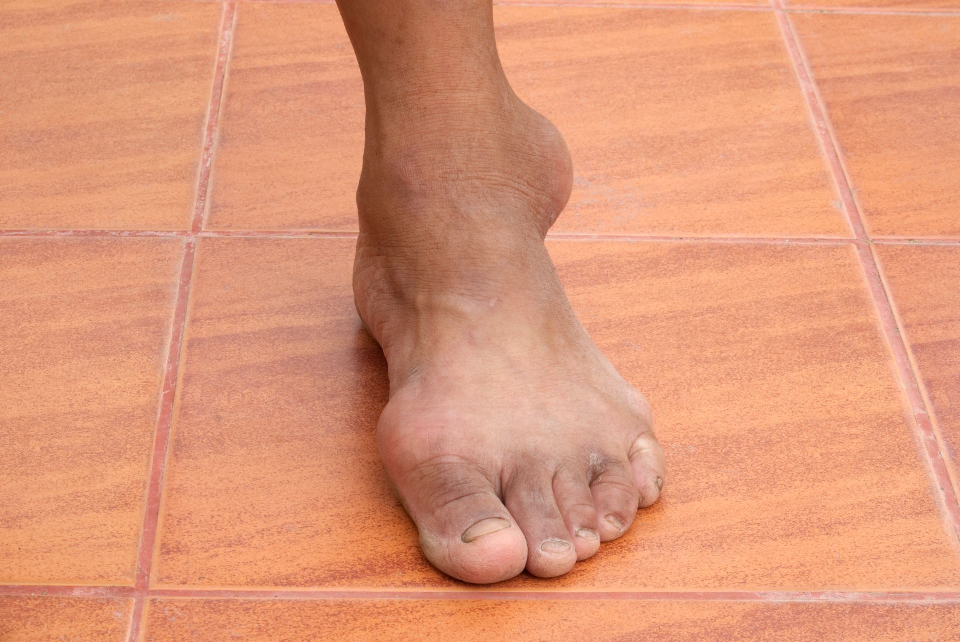 Foot with a bunion, standing on orange tiled floor.