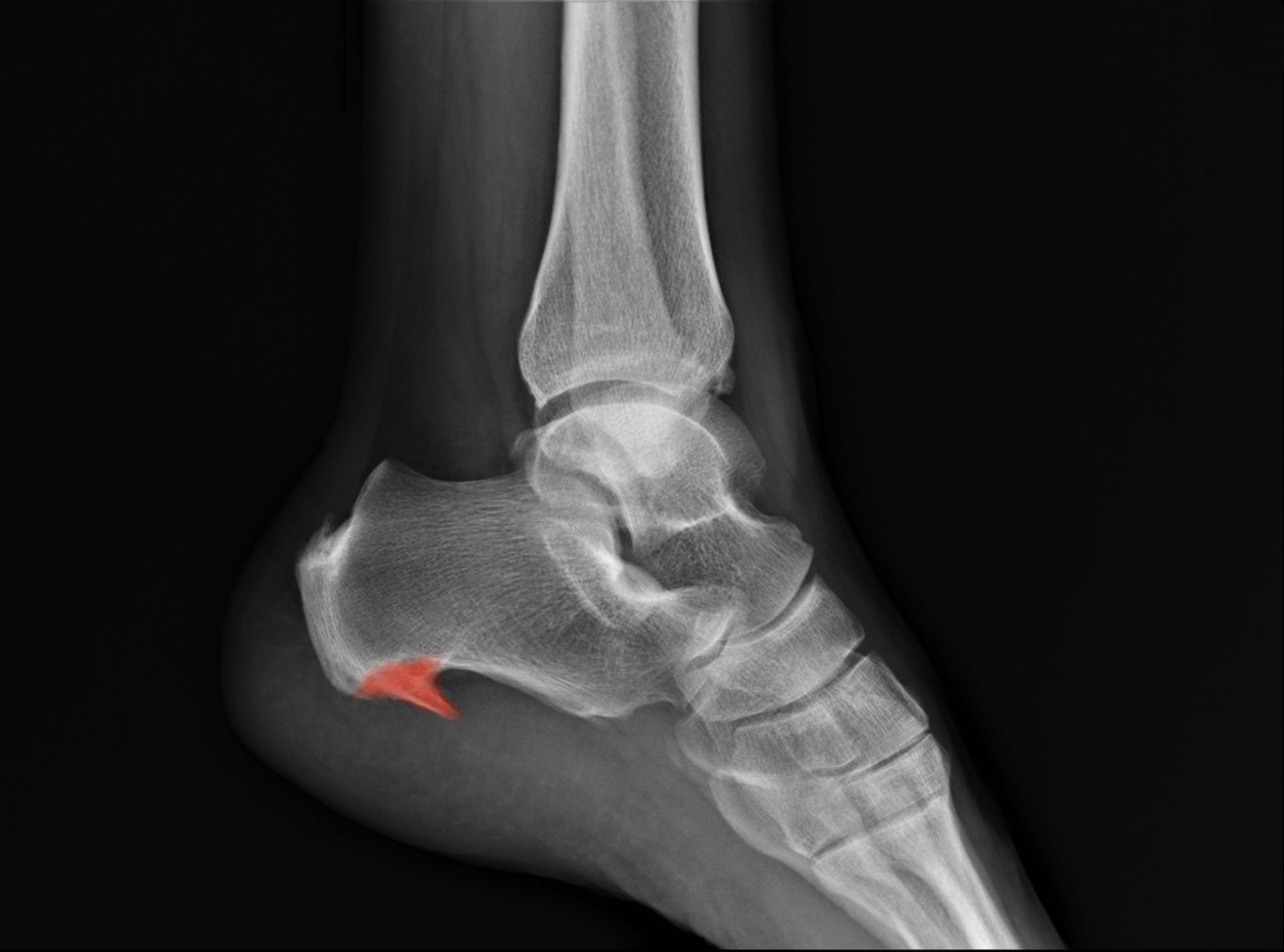 X-ray of a foot, showing the heel bone highlighted in red.