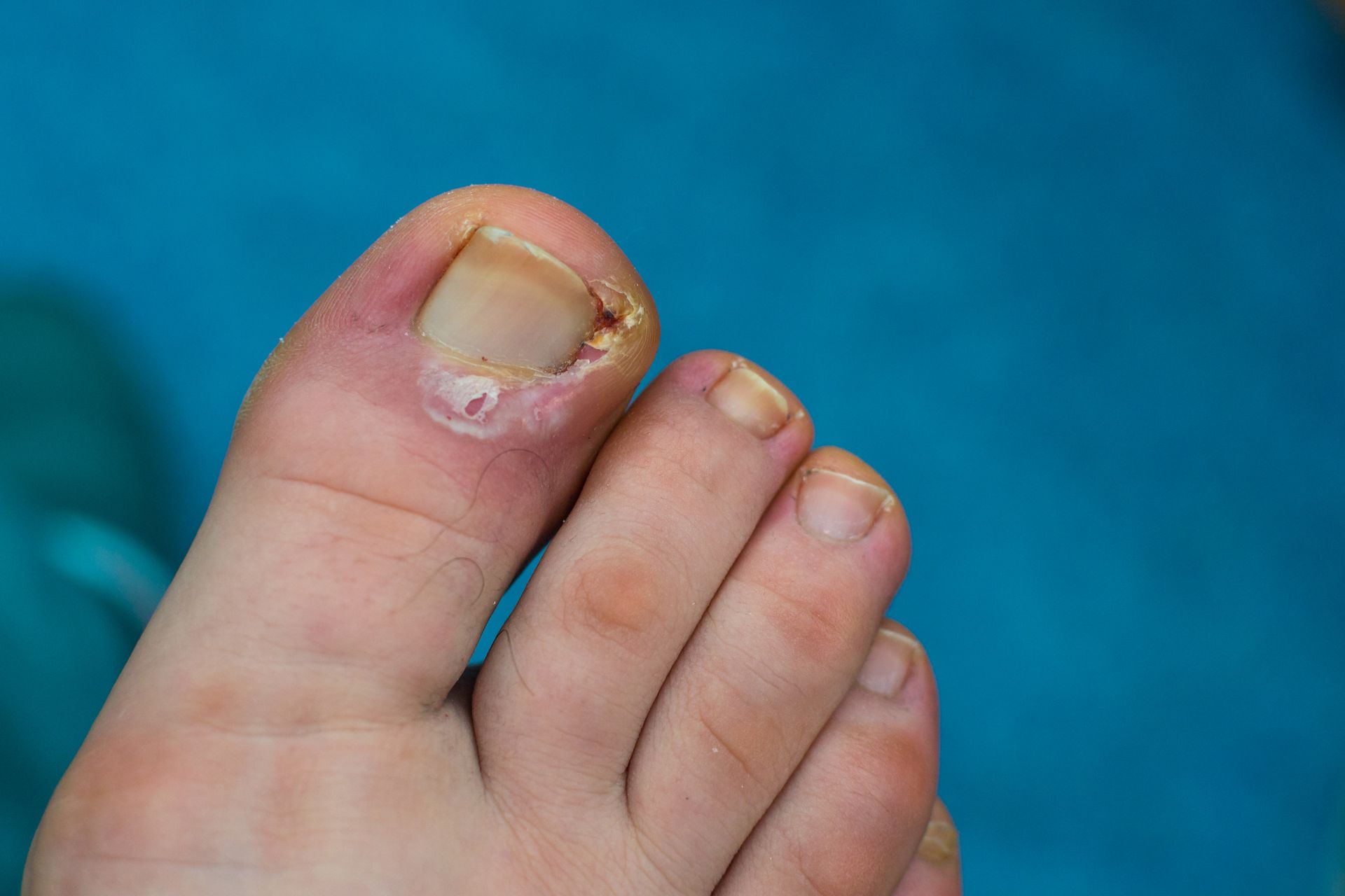 Toe with an infected nail; red skin surrounds the nail bed, nail is discolored and lifting.