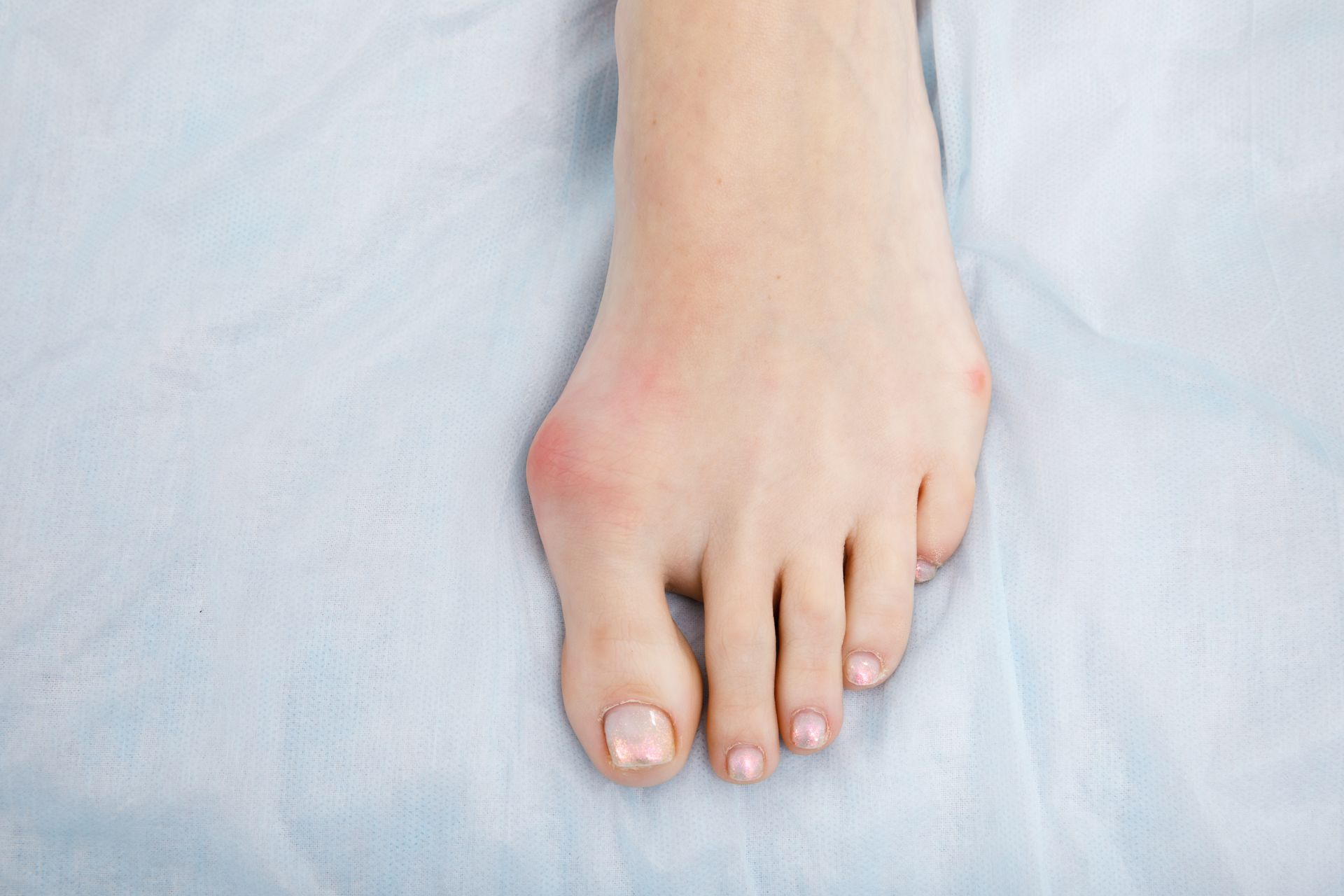 Foot with a bunion on the big toe, viewed from above, on a light blue surface.