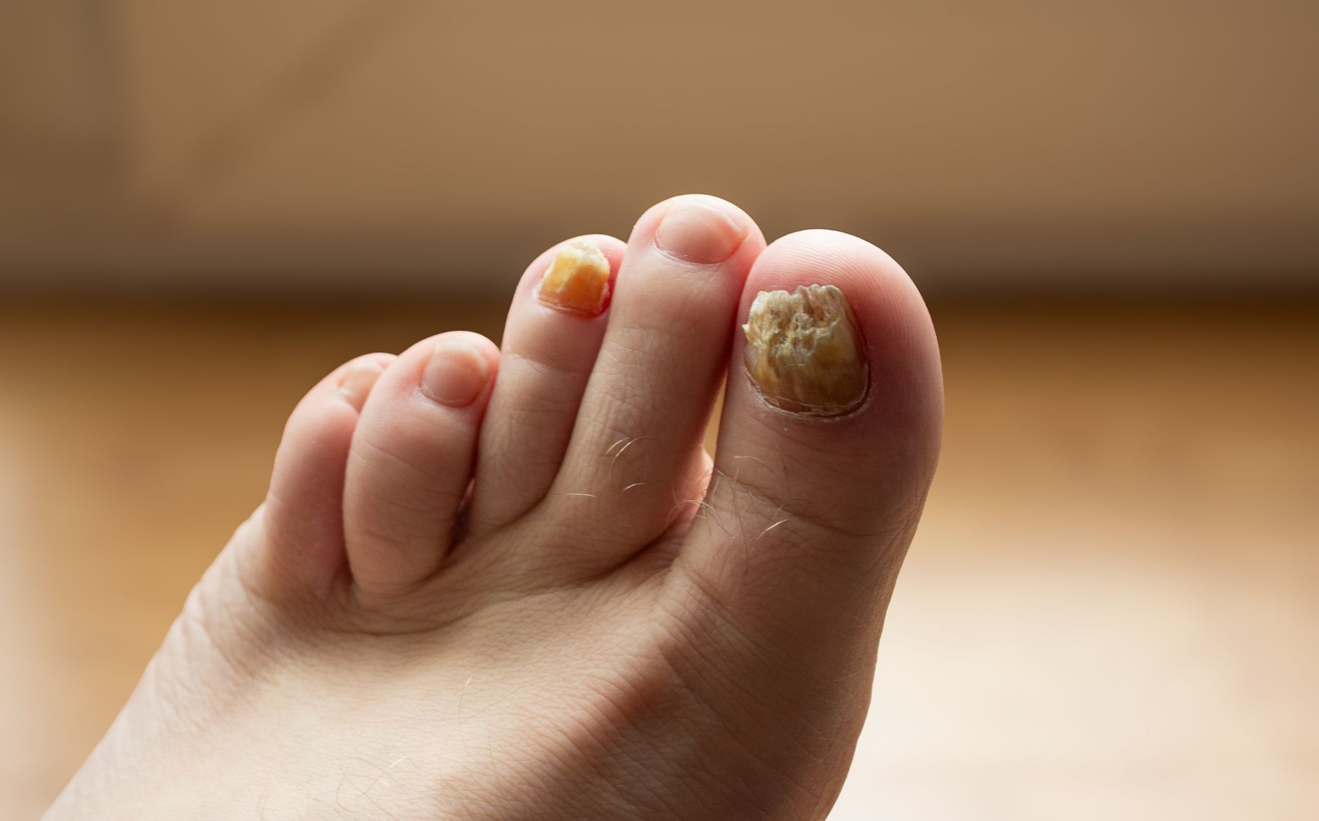Foot with toenail fungus, characterized by yellowing and thickening of the nails.