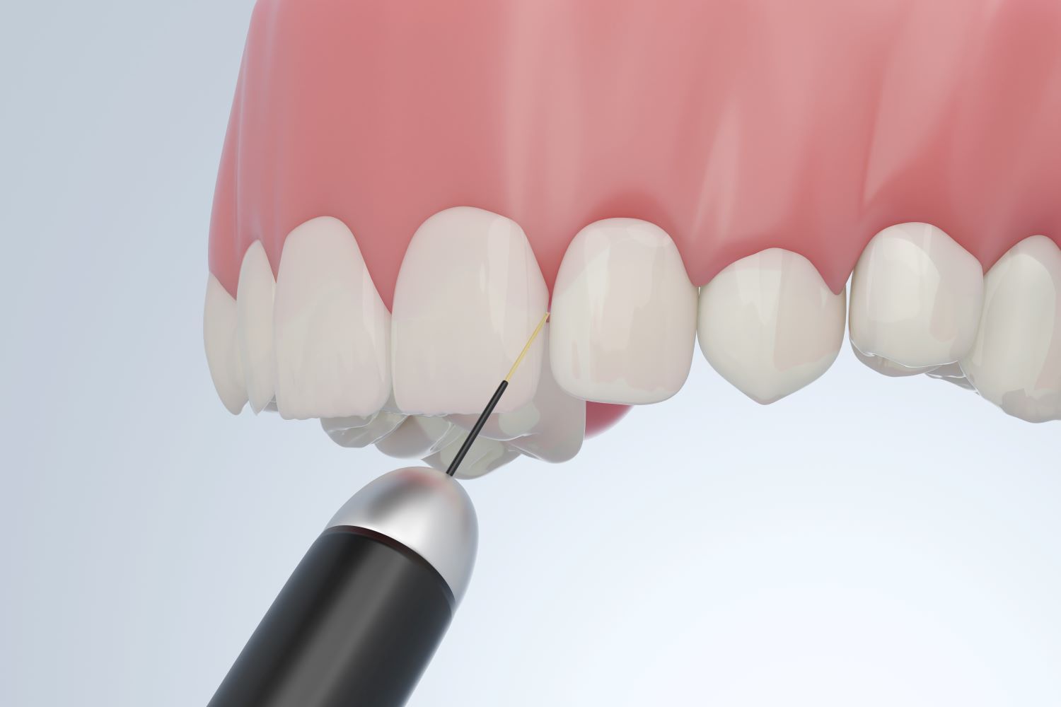 A close up of a person 's teeth with a drill in it.