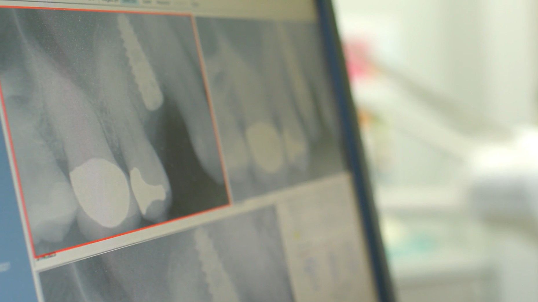 A close up of an x-ray of a person 's teeth on a computer screen.