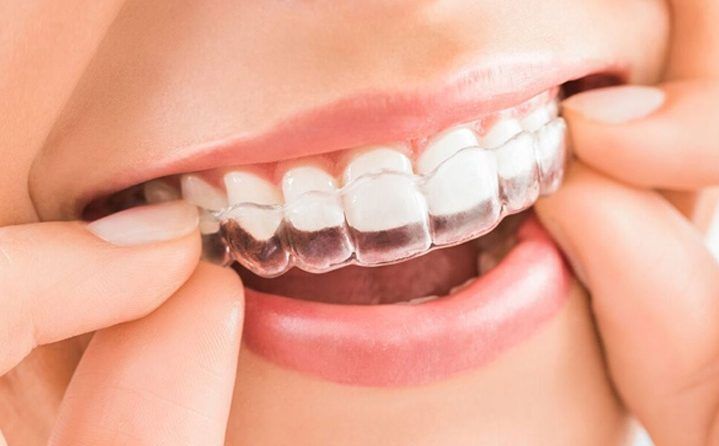 A woman is wearing invisible braces on her teeth.