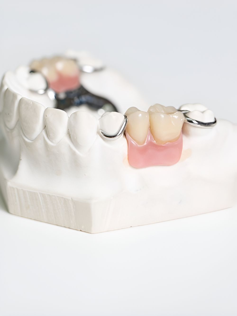 A Model of a Person 's Teeth With a Dental Bridge on It — Buderim Denture Studio in Buderim QLD