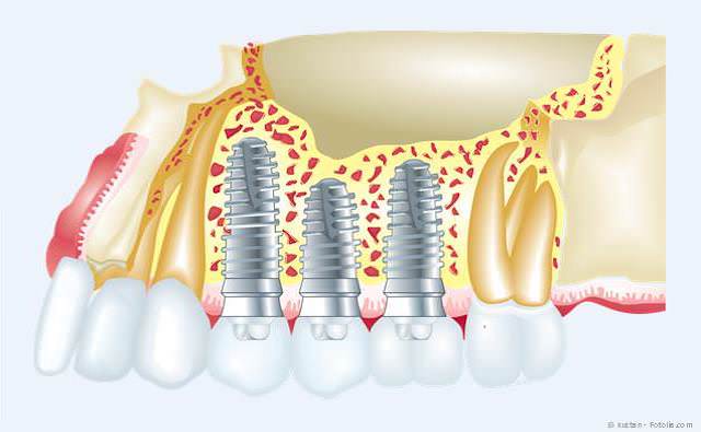 Implantate ersetzen fehlende Zähne. Implantate ersetzen fehlende Zähne.