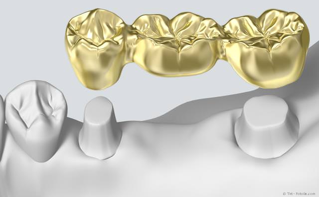 Für eine Zahnbrücke müssten die Nachbarzähne abgeschliffen werden. Bei Implantaten ist das nicht erforderlich. Für eine Zahnbrücke müssten die Nachbarzähne abgeschliffen werden. Bei Implantaten ist das nicht erforderlich.