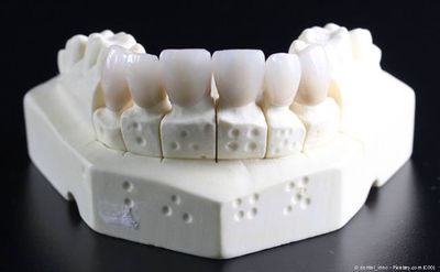 Zahnkronen aus reiner Keramik auf dem Gipsmodell: Ästhetisch und gut körperverträglich