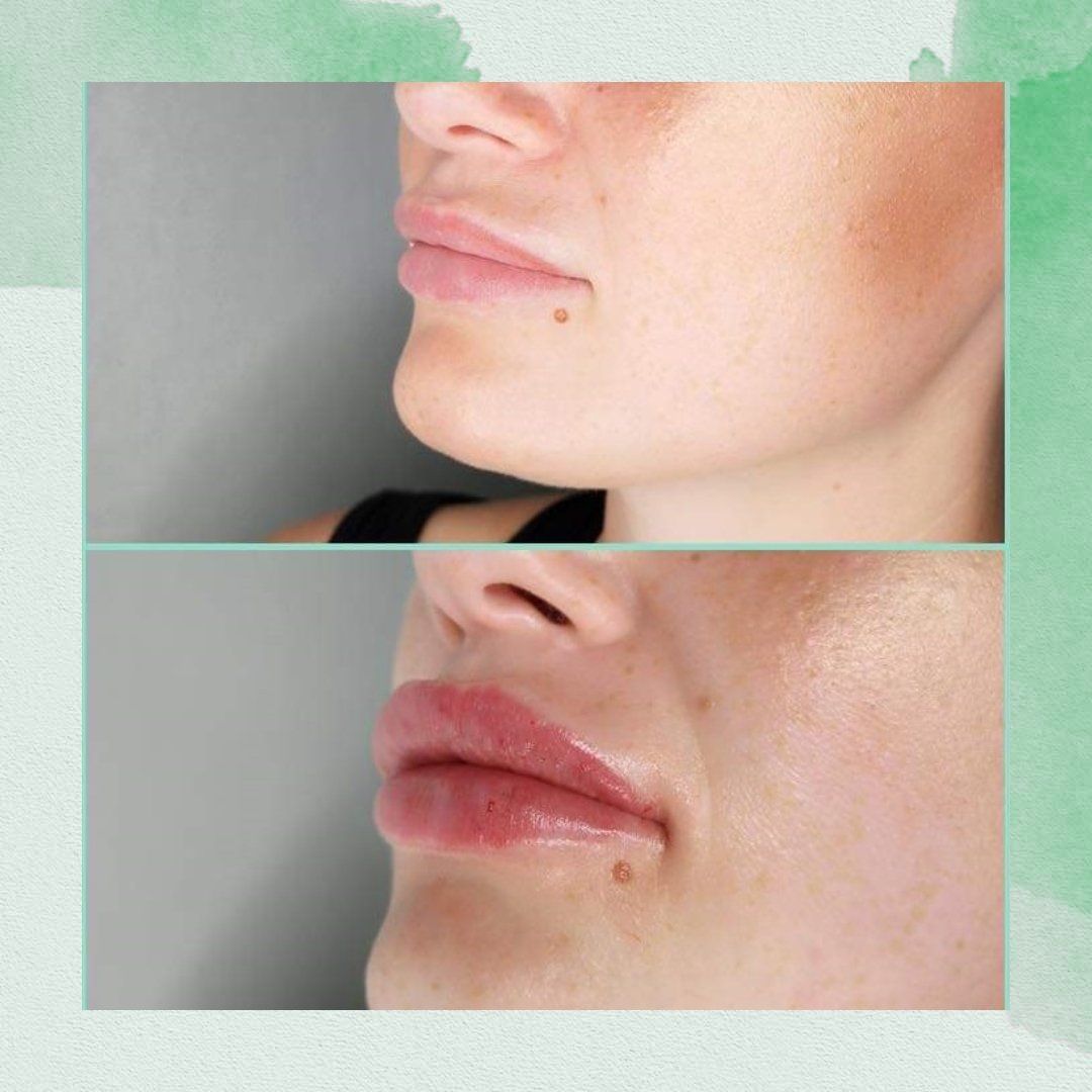 Lip Filler Treatment